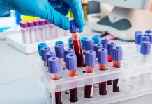 রক্তের গ্রুপ ‘এ’ হলে করোনা ঝুঁকি বেশি: চীনের গবেষকদের একটি প্রতিবেদন