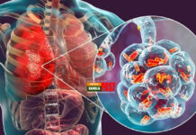 নিউমোনিয়া কেন হয়, লক্ষণ কি এবং প্রতিকার-প্রতিরোধ