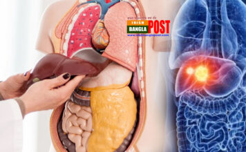 লিভার সিরোসিসের কারণ কী, লক্ষণ ও চিকিৎসা